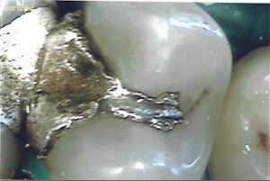 dental fillings Salisbury